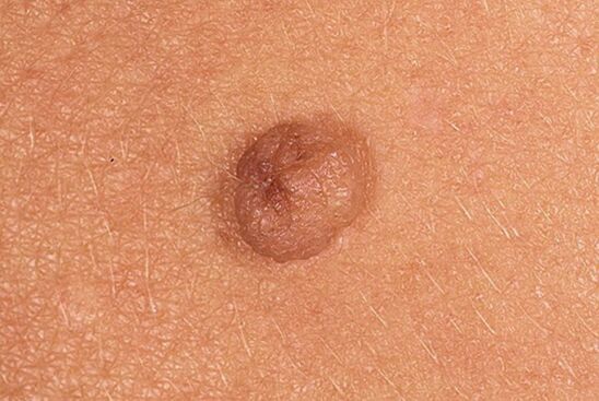 Preprost papiloma